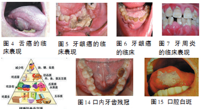 cd44v6与人乳头瘤病毒在宫颈鳞癌及癌前病变中的相关性研究