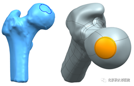 矫形骨科首创3D打印定制化部分髋关节置换术