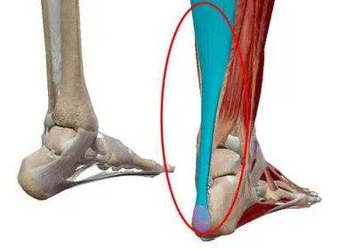 阿基里斯之痛跟腱炎的病因与保护